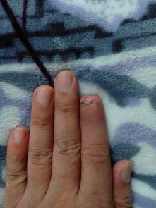 女生左手食指侧面有痣代表
