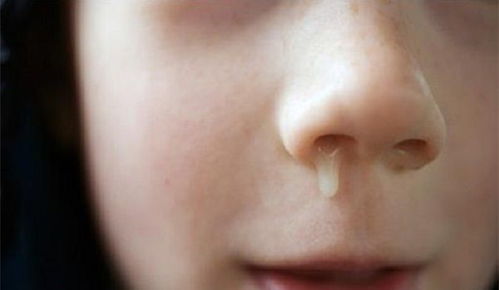 鼻子里流出黄水是大病 小孩吐黄水是怎么回事？ 