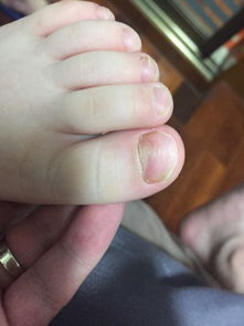 宝宝脚趾甲不平整 大脚趾甲怎么好像要脱落的感觉,还有点发黄 哪位好医生帮帮我 