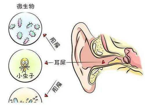 耳屎可以用棉签掏吗 正确的掏耳朵姿势应该是什么