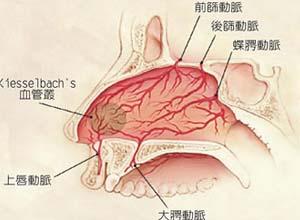 鼻腔前部出血