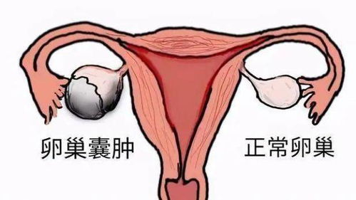 囊肿是什么病严重吗 女性，卵巢囊肿是什么病严重吗