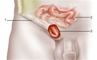 腹股沟疝气，腹股沟疝气的症状主要表现有哪些