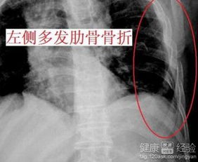 肋骨骨折固定方法图片 搜狗图片搜索