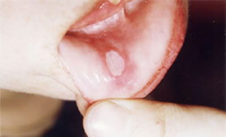 口腔溃疡含维c为什么会脱皮