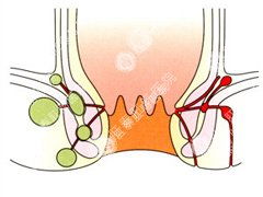 肛瘘手术原理