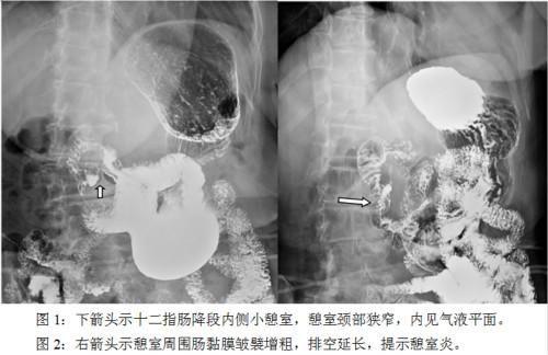 十二指肠憩室怎么治疗