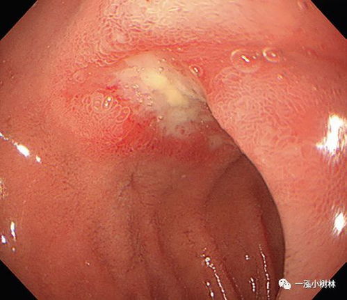 子 腸 潰瘍 12 十二指腸潰瘍