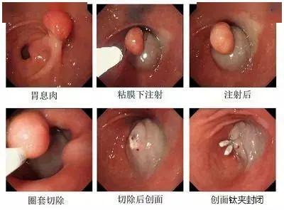 胃息肉,到底要不要斩草除根,这一篇说的最详细