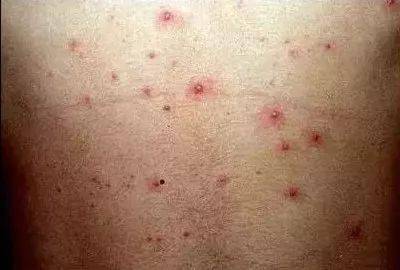 急疹 湿疹 风疹 水痘 幼儿各种疹子的症状及护理