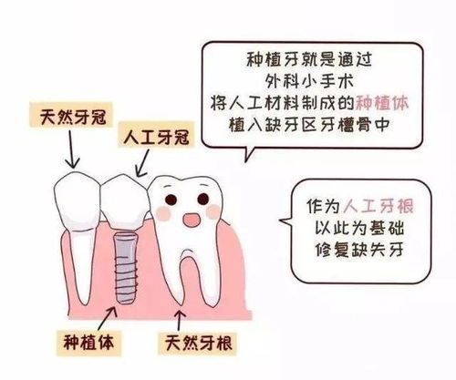 听说种植牙对人体有害 是真的吗