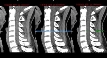 您好,我前段拍的x片,说是颈椎曲直有两节骨质增生,现在我每天早晨后背很疼,请问您是哪的医生, 