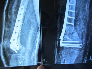 股骨远端骨折术后锁定钢板断裂
