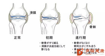 干细胞治疗 早知道不做关节置换手术了,直接干细胞治疗