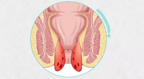 疾病科普丨发生内痔脱出时,你最应该做的几件事
