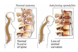 强直性脊柱炎