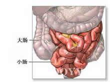 急性出血性坏死性肠炎