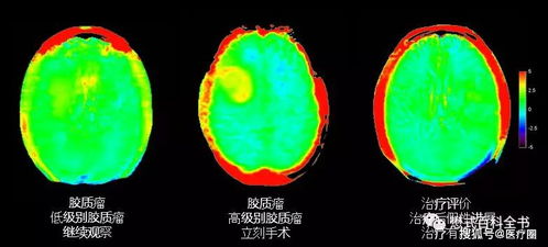 穷人 的分子影像学 APT