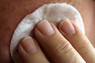 打耳洞后的护肤小窍门：红霉素软膏的神奇功效