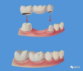 为什么我缺了一颗牙,医生却让镶我三颗