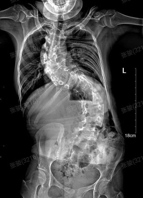 17岁少女因为这病从小抬不起头,如今终于挺直腰杆