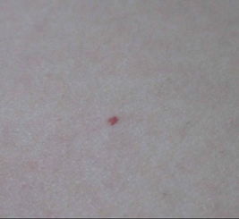 皮肤上出现了血红色的红点,还有几乎透明的血红色的红疙瘩 