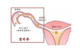 做了宫外孕手术后一个月，来的月经特别少都是深褐色，是怎么回事啊？我好害怕