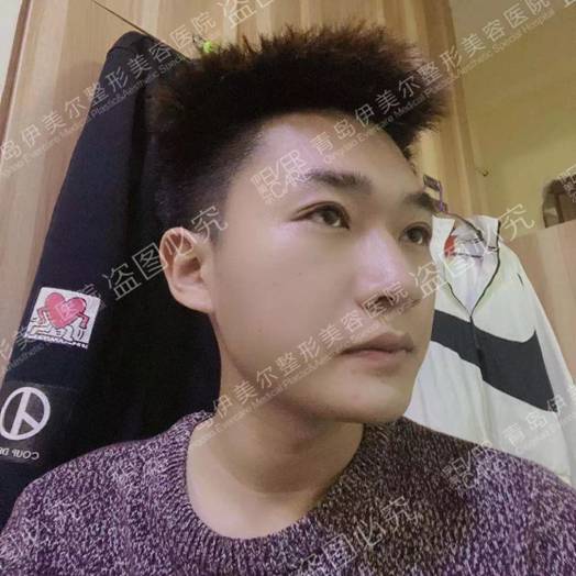 难道男生割双眼皮恢复的快吗 青岛伊美尔单文涛给我做的5s恢复好快 