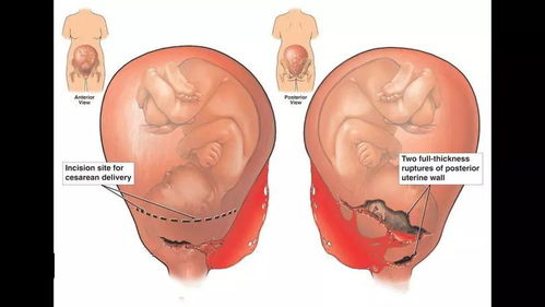 女人一生最多能做几次剖宫产 超过这个次数,子宫接近报废