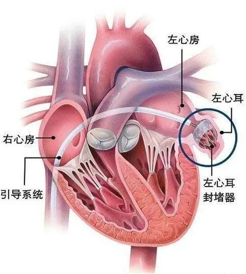 捂住耳朵 防卒中 这项微创手术可从源头上预防