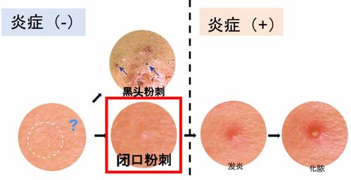 脸上全是密密麻麻的闭口怎么办