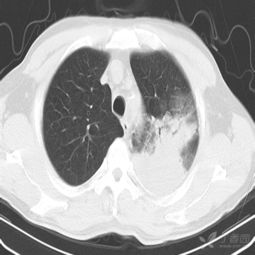 左肺病变是什么 看你的 已公布复查CT,已经公布病理 影像医学和核医学讨论版 