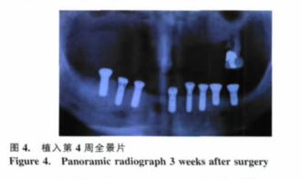 赖红昌教授解析 下颌无牙颌种植固定修复