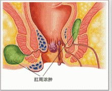 详解肛门脓肿的成因