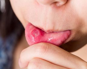 你的口腔溃疡可能是舌癌,治疗超2周不见好转需警惕了 