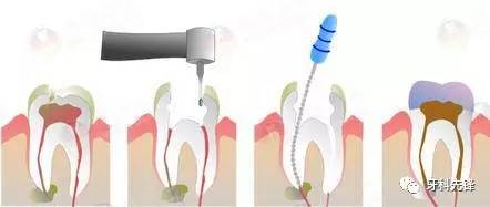 第一次根管治疗,原来这些地方要注意... 
