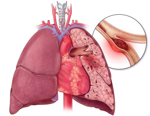 9岁孩子得肺血栓 提醒 若有这4种症状,需警惕肺血栓的出现