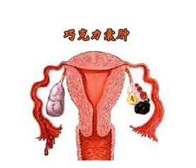 卵巢巧克力囊肿能怀孕吗(巧克力囊肿)
