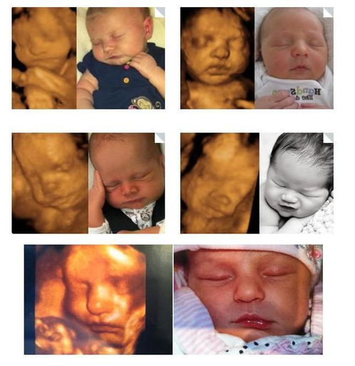 胎儿四维彩超照片 四维照片跟真婴儿对比一点也不像是怎么回事