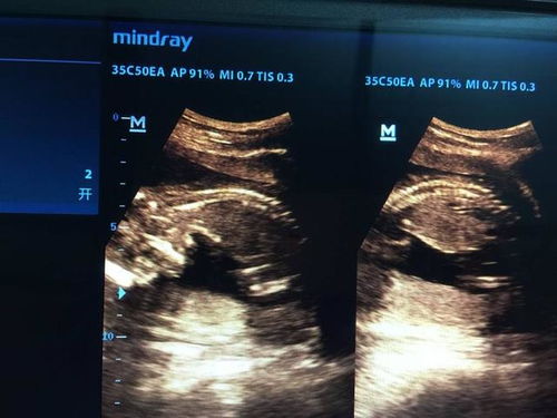 四个月的胎儿(四个月的胎儿是什么样子)