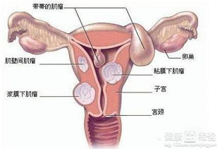 患子宫肌瘤能怀孕吗