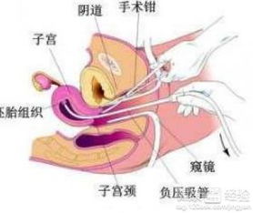 人流手术B超的作用