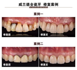 牙齿修复 常州烤瓷牙 德国威兰德全瓷牙 美好生活从微笑开始 悦美整形 