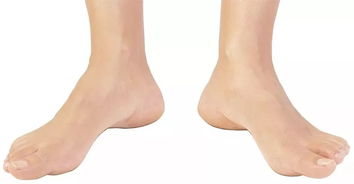 科普丨外八字脚对跑步的影响及其衍生伤病的治疗方法 