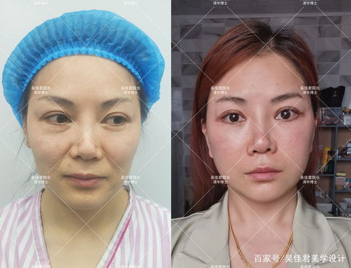 34岁拉皮术后5个月,脸型改变很大,减龄效果很明显