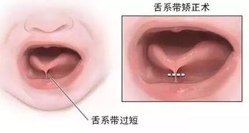 医生,我家孩子发音不清怎么办 是舌系带的问题吗 