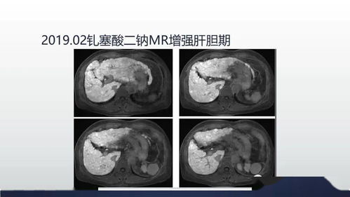 肝上长了结节，问题大吗结节多大才是正常的