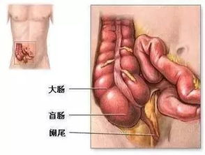 身体出现这3大症状,说明你极有可能得了阑尾炎