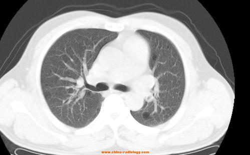影联网 肺部多发囊状低密度影 
