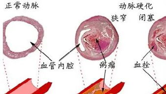 肝不好,血糖也遭殃